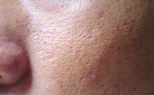 脸上有螨虫怎么彻底消灭,脸上有螨虫怎么消灭螨虫