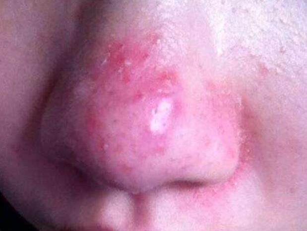 脸上有螨虫怎么彻底消灭,脸上有螨虫怎么消灭螨虫