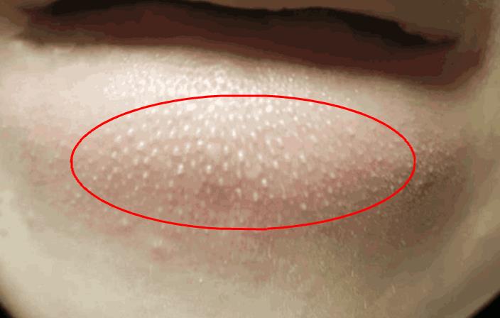 脸上有螨虫怎么彻底消灭,脸上有螨虫怎么消灭螨虫