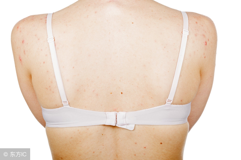 后背螨虫最佳去除方法,后背长螨虫解决方法