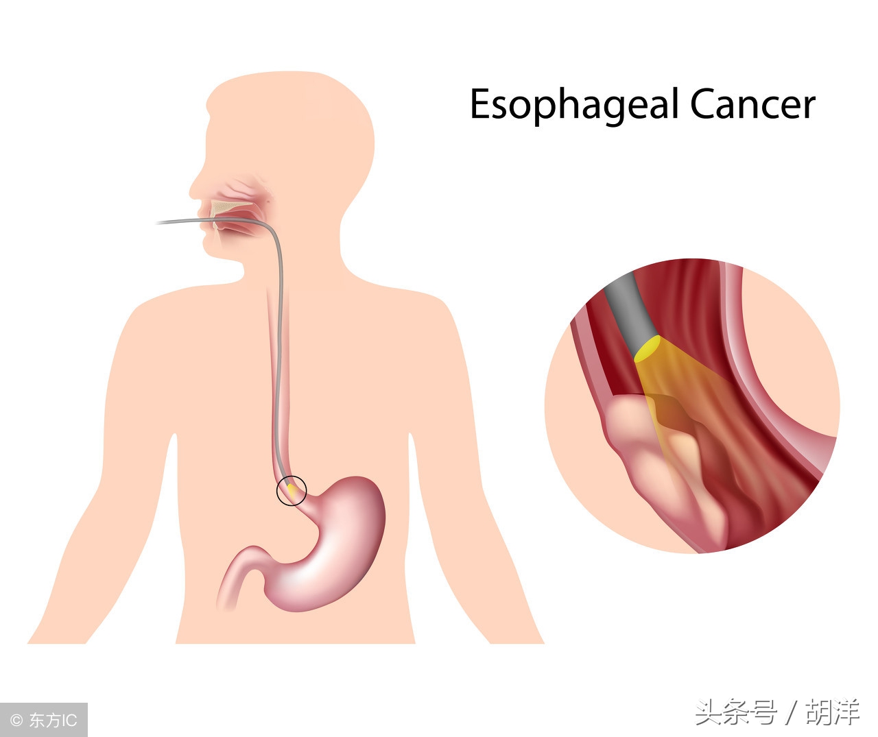用什么机器能查出食管癌早期,医生一招搞定食管癌