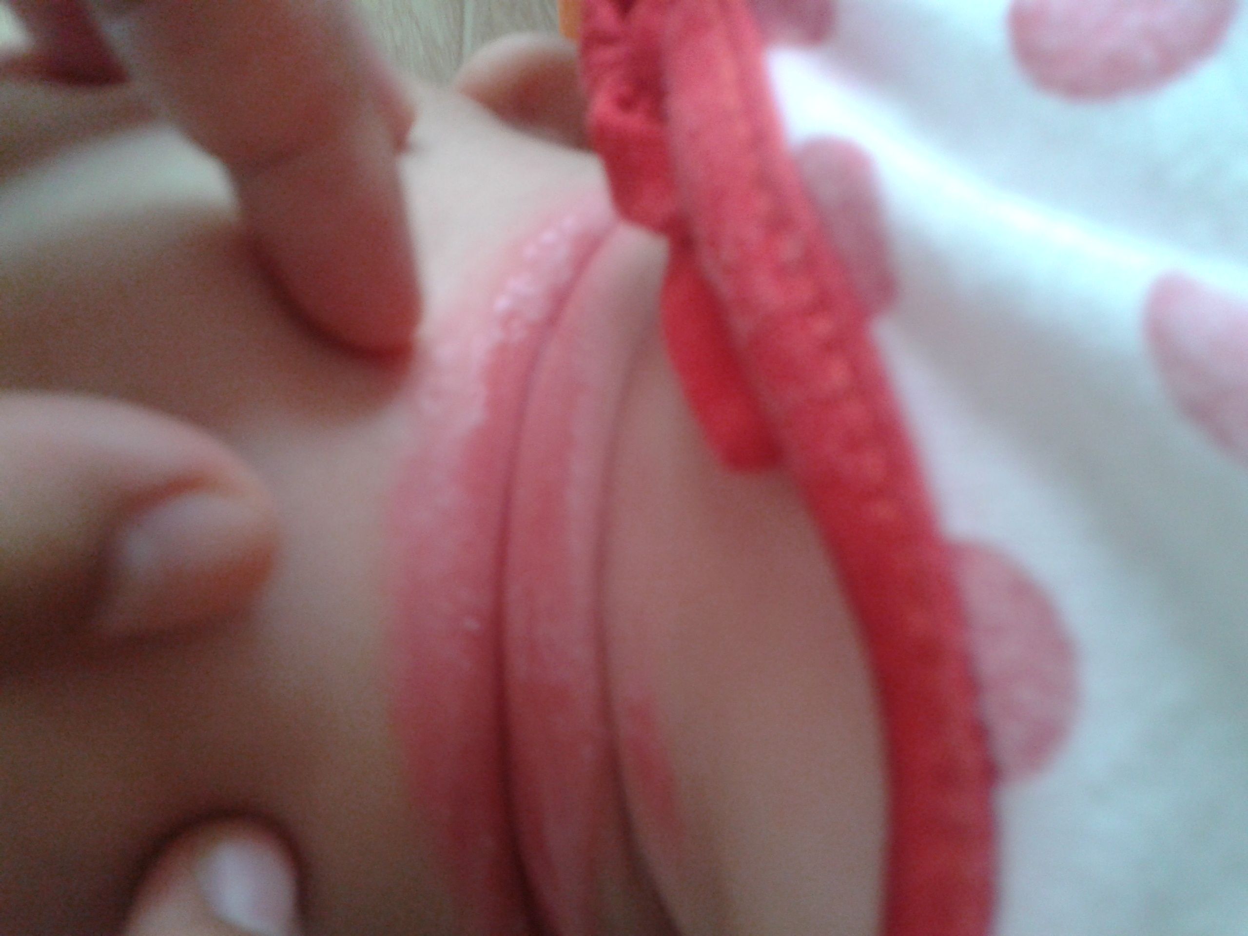 宝宝淹脖子用什么方法解决,宝宝淹脖子是什么原因引起的