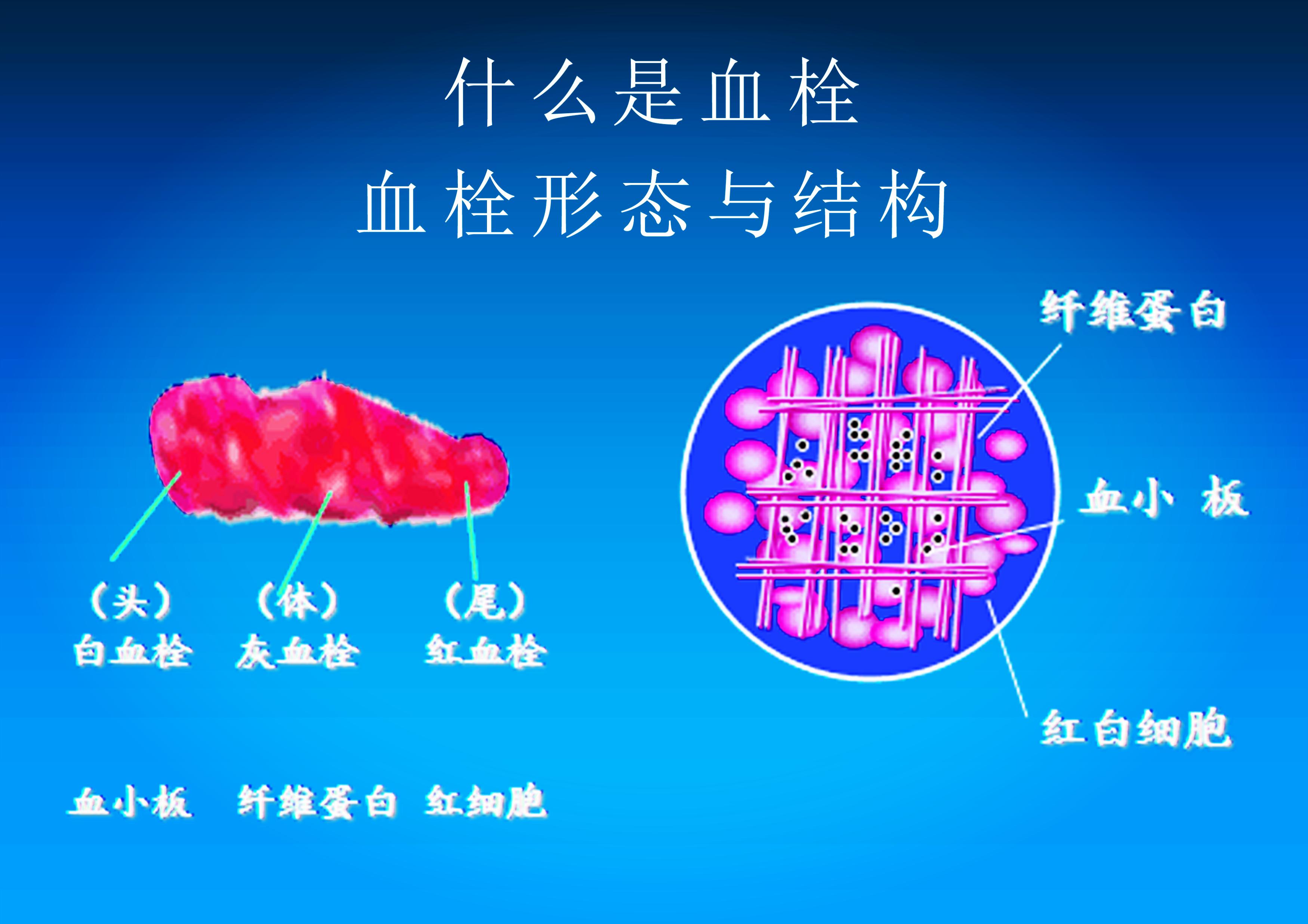 为什么活血化瘀反而能止血,溶解血栓和血管斑块的药有哪些