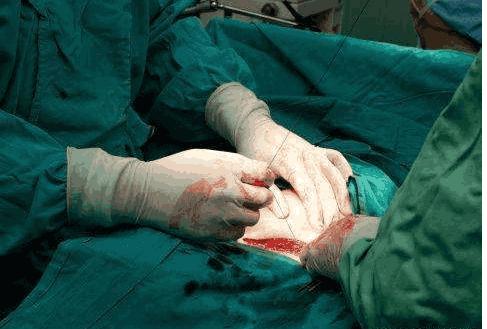 剖腹产打的麻药有什么副作用,剖腹产有哪些副作用和后遗症