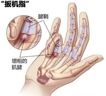 抱小孩引起的手腕痛可以痊愈的吗,抱宝宝手腕疼得厉害需要看医生