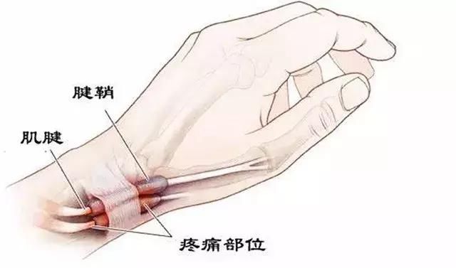 抱小孩引起的手腕痛可以痊愈的吗,抱宝宝手腕疼得厉害需要看医生