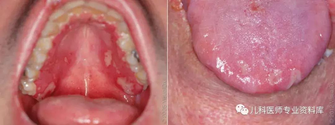 宝宝嘴巴上火了擦什么药膏好,嘴巴上火一圈红怎么办