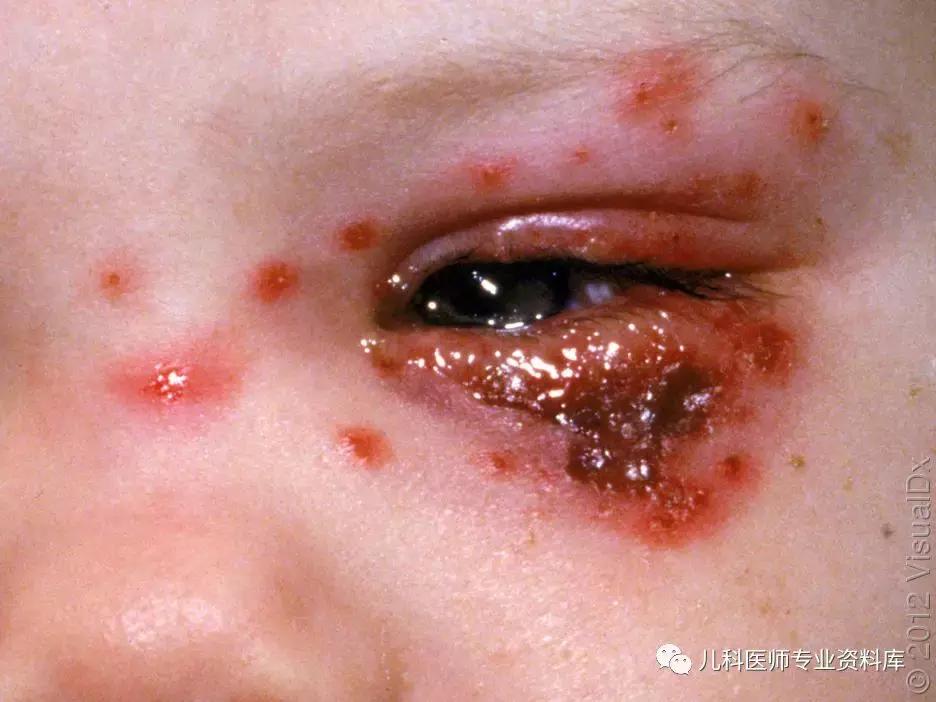 宝宝嘴巴上火了擦什么药膏好,嘴巴上火一圈红怎么办