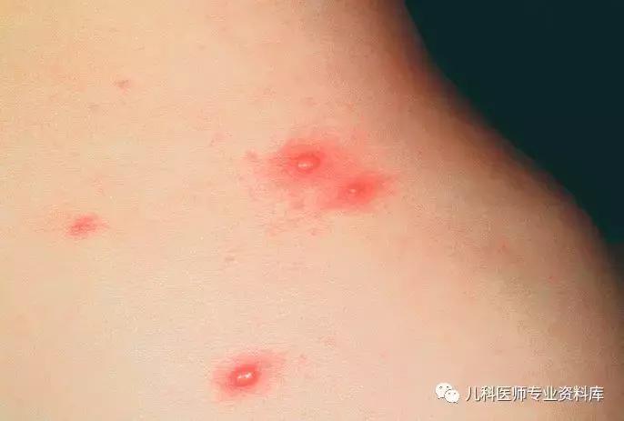 宝宝嘴巴上火了擦什么药膏好,嘴巴上火一圈红怎么办