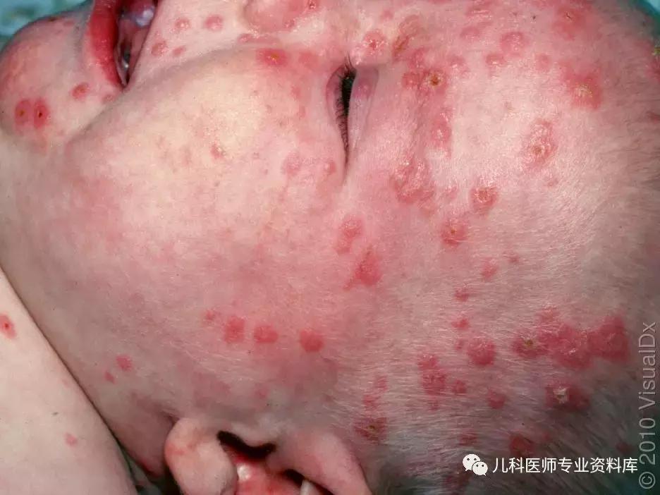 宝宝嘴巴上火了擦什么药膏好,嘴巴上火一圈红怎么办