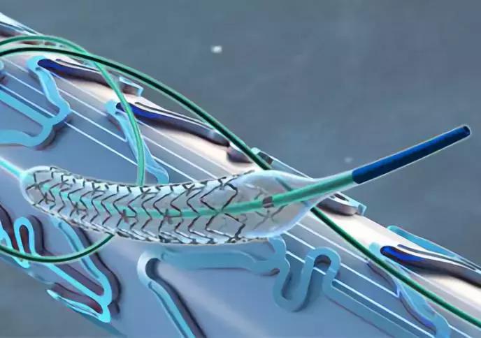 中国国产医疗器械的突破,中国医疗器械行业突破