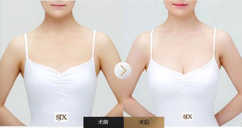 产后乳房干瘪下垂怎么中药调理,产后身材变形婚姻危机