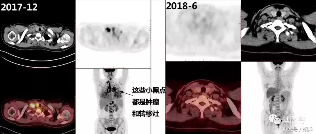 基因检测在癌症诊疗上的最新应用