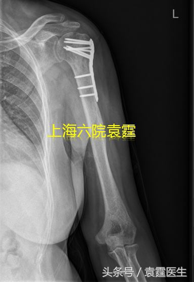 肩周肿瘤怎么治疗最好,肩痛患者诊治流程