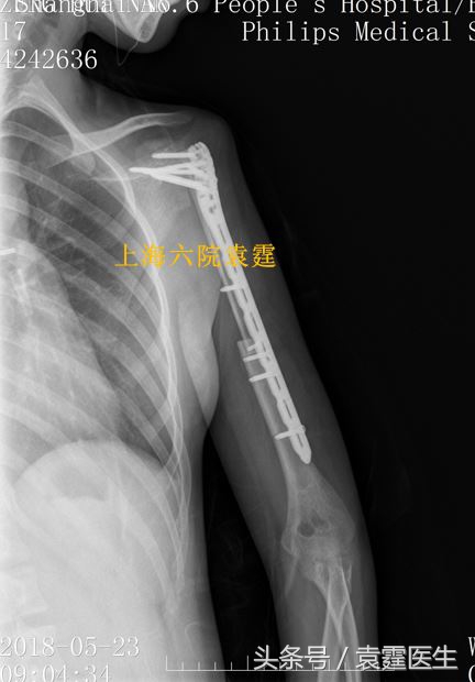 肩周肿瘤怎么治疗最好,肩痛患者诊治流程