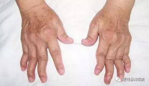 大妈治疗风湿,祖传秘方治类风湿关节炎