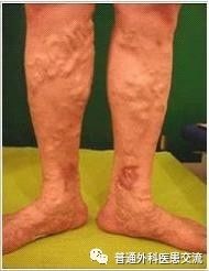 静脉曲张对身体有什么危害,静脉曲张剥脱术对身体有影响吗