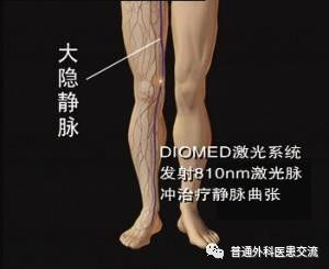 静脉曲张对身体有什么危害,静脉曲张剥脱术对身体有影响吗