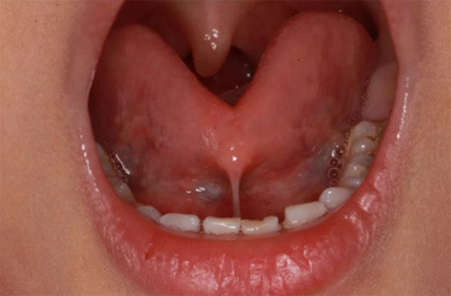 孩子发音不清楚是舌头的原因吗,舌系带过短怎么锻炼发音