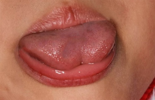 孩子发音不清楚是舌头的原因吗,舌系带过短怎么锻炼发音