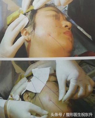 做线雕疼吗说说感受,线雕真实感受