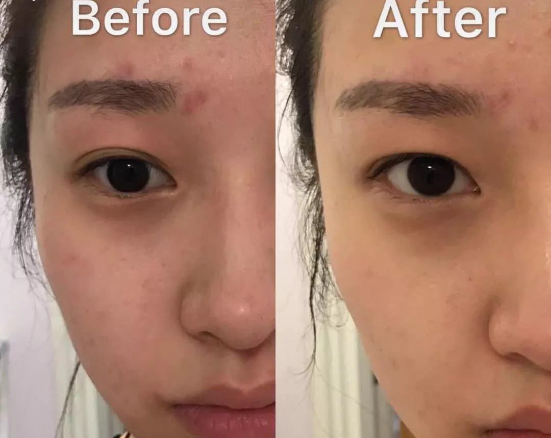 周迅20年前就一脸斑?日本30天击碎顽固斑的好物,快让她用用!