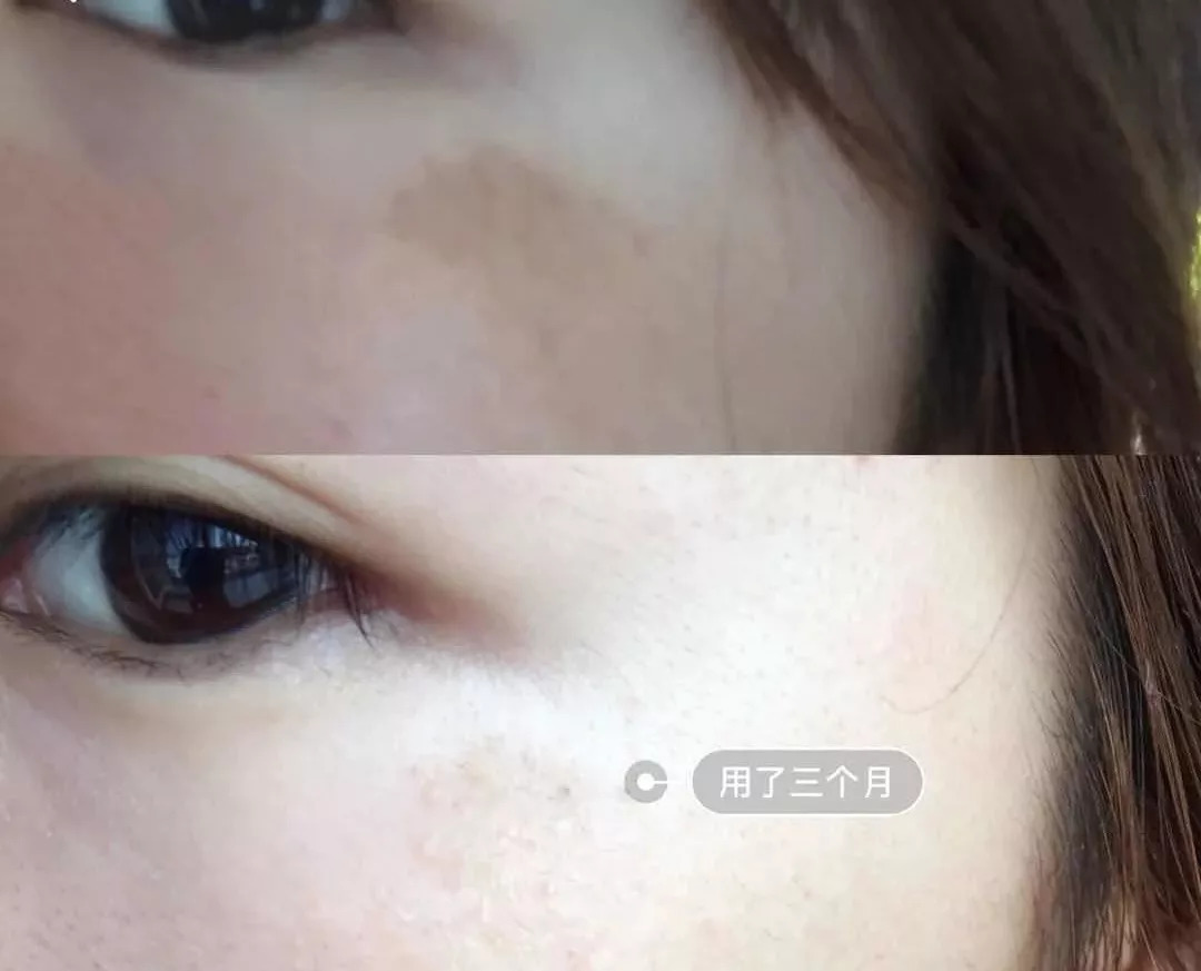 周迅20年前就一脸斑?日本30天击碎顽固斑的好物,快让她用用!