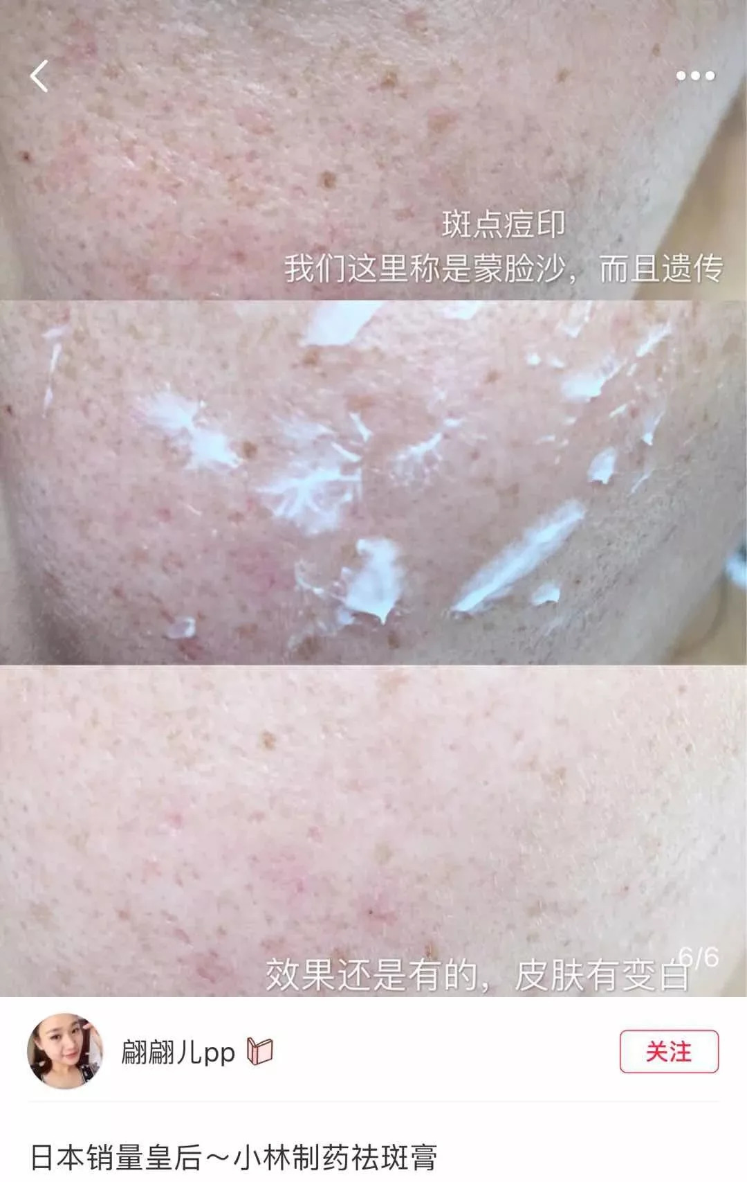 周迅20年前就一脸斑?日本30天击碎顽固斑的好物,快让她用用!