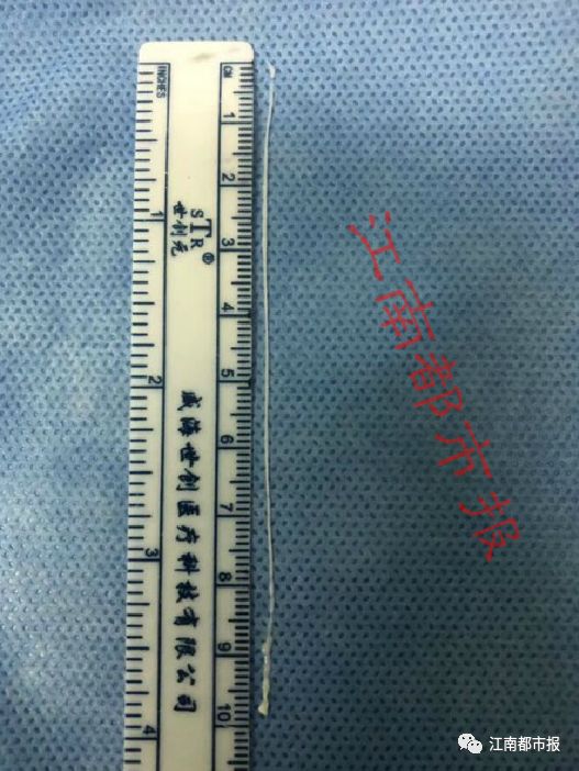 女子脑内取出活虫这是什么虫,男子颅内长活虫