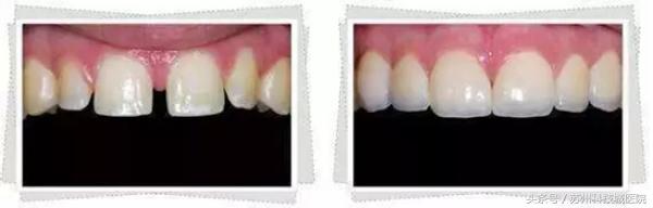 30岁门牙有道缝怎么办,我的门牙有缝