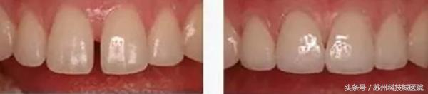 30岁门牙有道缝怎么办,我的门牙有缝