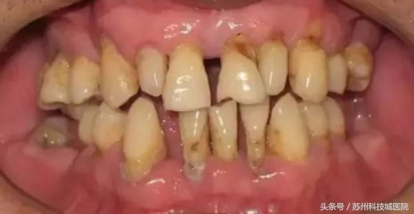 30岁门牙有道缝怎么办,我的门牙有缝