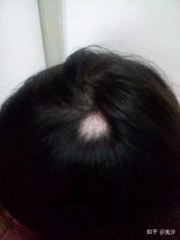 脱发发际线后移你的头发都还好吗,头发快秃顶了怎么解决