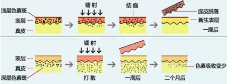 激光祛斑后斑反弹更严重,西南医院激光祛斑会反弹吗