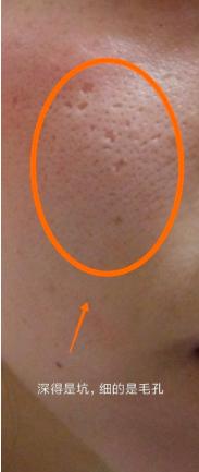 如何去改善t区毛孔粗大,细腻皮肤收缩毛孔零基础学起来