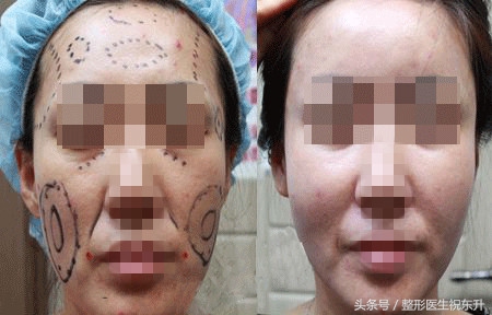 自体脂肪术后注意事项,自体脂肪脸部填充不忌口会怎样