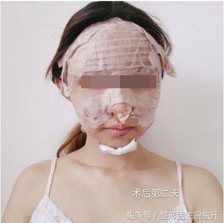 自体脂肪术后注意事项,自体脂肪脸部填充不忌口会怎样