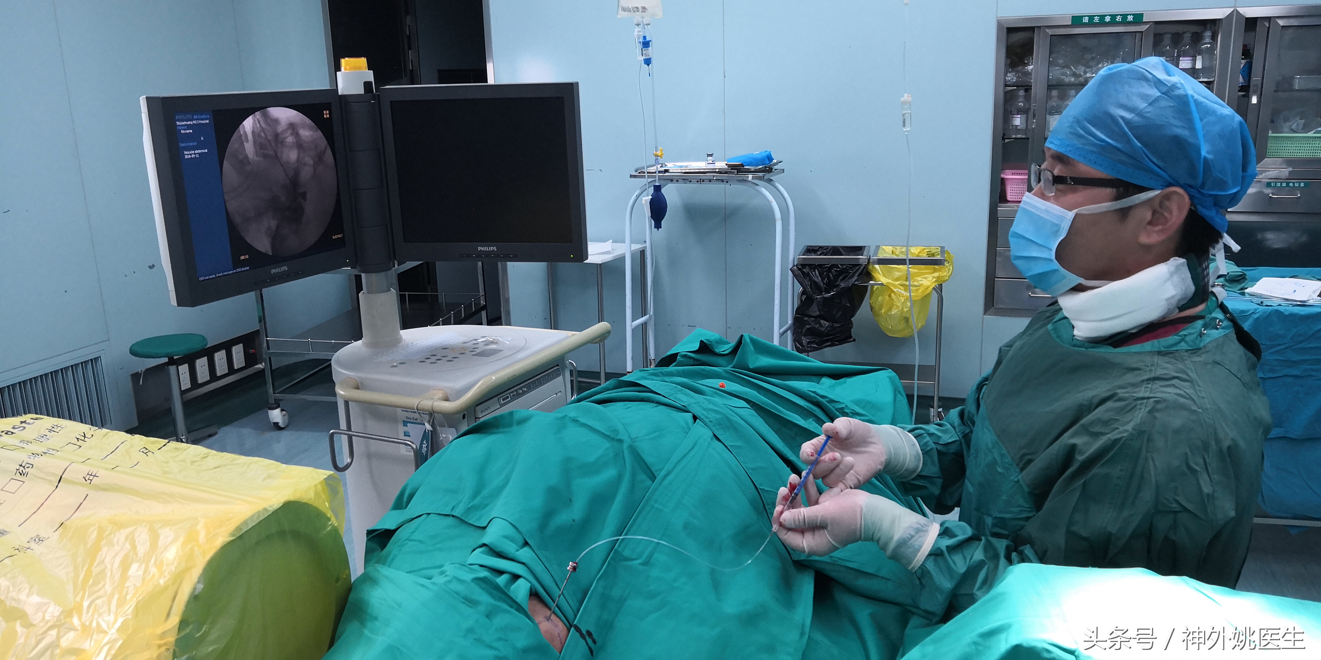 经皮穿刺半月神经节微球囊压迫术,经皮穿刺微球囊压迫术是几级手术