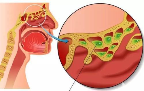 慢性咽炎不好治吧,慢性咽炎吃什么药好得快能根治