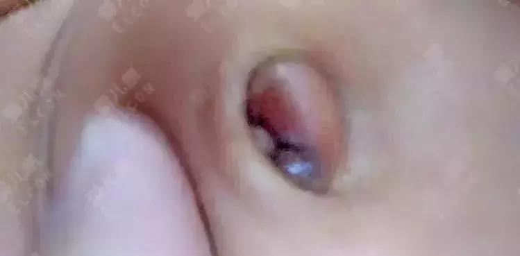 宝宝肚脐长好了还需要护理吗,宝宝肚脐留得太长