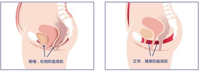 产后恢复，盆底康复很重要！