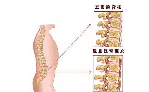 偏方治强直运动治愈案例,治疗强直副作用小的药