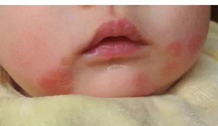 润肤霜怎么治疗湿疹,湿疹治疗误区有哪些呢