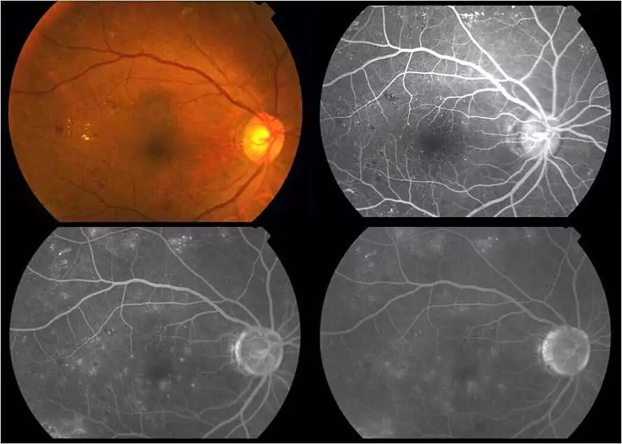 青少年近视弱视矫正,儿童近视1000多度加弱视能治好吗