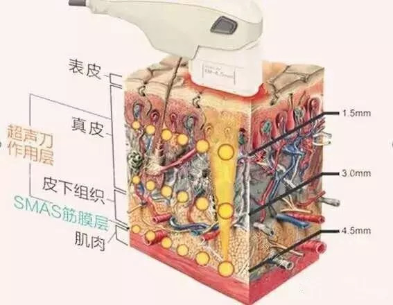 美容超声刀真的有效吗,美容超声刀是啥