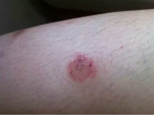 猫癣介绍,猫有猫癣摸一下会被传染吗