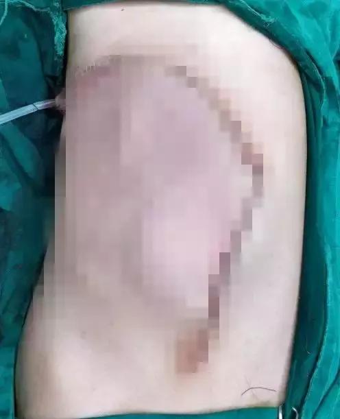罕见！肝脏长出体外12年，被医生塞回少女身体内！