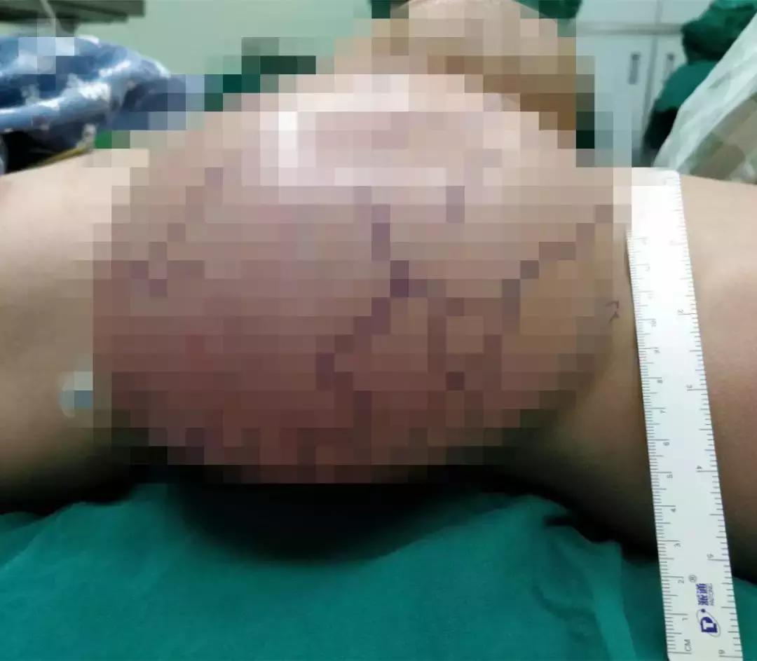 罕见！肝脏长出体外12年，被医生塞回少女身体内！