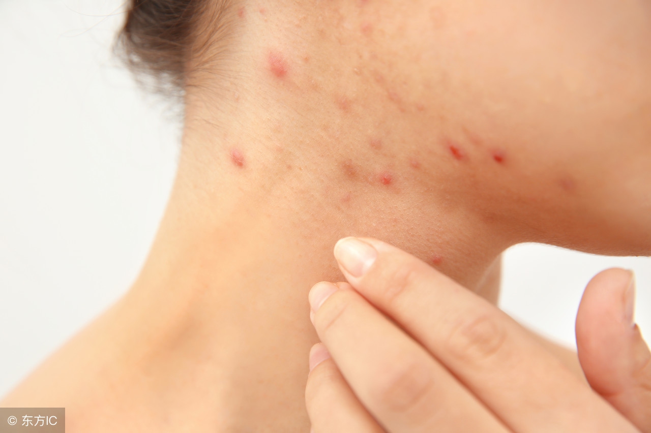 宝宝被蚊子咬了红肿厉害怎么办,蚊子咬了红肿痒擦什么药膏好得快