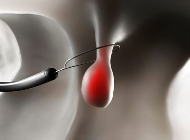 身上的小息肉可以割掉吗,身上到处长息肉怎么解决